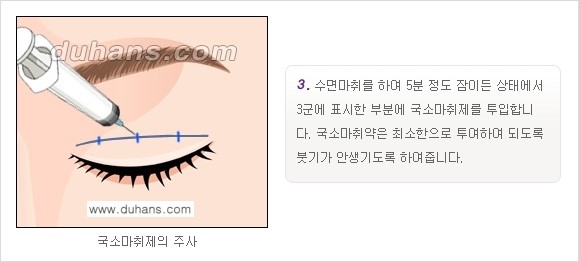 [두한성형외과 경쟁력 눈성형]- [최소 부기로 일상의로의 복귀가 가능한 아름다운 퀵쌍꺼풀(부분절개법) 수술] 관련 이미지 3