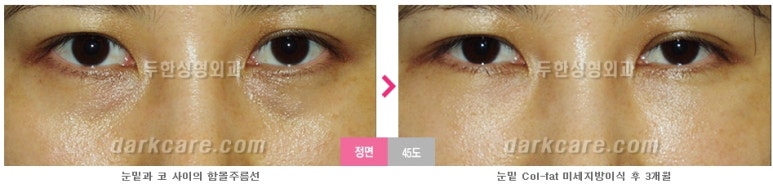 [두한성형외과 다크서클] - [다크서클 전후사진 검증] 관련 이미지 85