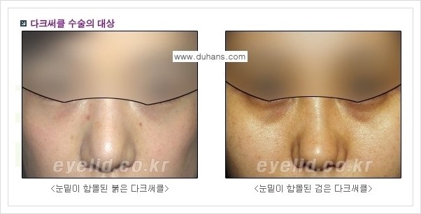 [두한성형외과 경쟁력 눈밑성형] - [다크써클 수술 안내 1.] 관련 이미지 1