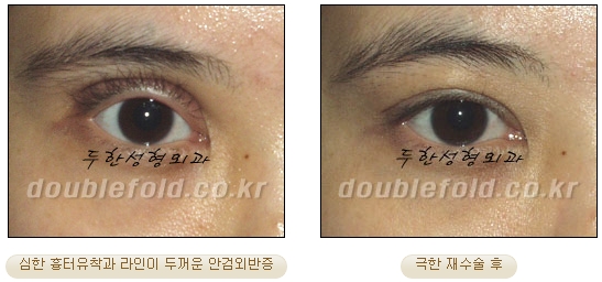 [DoubleFold Plastic Surgery Eye Surgery] - [Revision Surgery for Thick Double Eyelids] image 40
