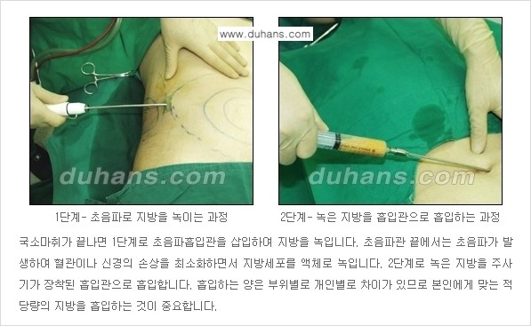 [두한성형외과 성형 FOCUS 간편 지방흡입] - [비만 탈출! 초음파 지방흡입 ②] 관련 이미지 5
