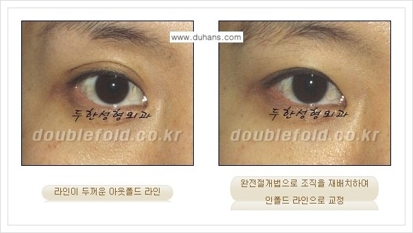 [두한성형외과 경쟁력 쌍꺼풀(눈) 재수술] - [심한 아웃폴드 라인을 인폴드 라인으로의 교정 안내] 관련 이미지 7