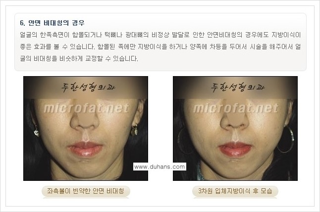 [두한성형외과 경쟁력 볼살지방이식] - [사각턱의 경우, 측면 볼살의 함몰선, 안면비대칭, 남성 야윈볼살 안내] 관련 이미지 8
