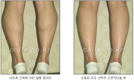 [두한성형외과 종아리퇴축술] - [NO절개! 초음파유도신경차단술] 관련 이미지 29