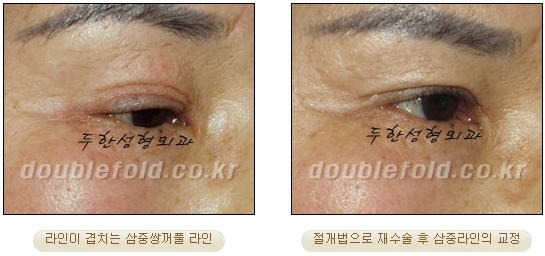 두한성형외과 쌍커풀재수술 - 삼중 쌍커풀 라인 교정 관련 이미지 28