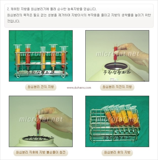 [두한성형외과 경쟁력 미세지방이식] - [타병원에서의 미세지방이식 이후 부작용 교정의 대상 안내] 관련 이미지 18