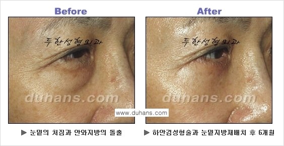 [두한성형외과의 상큼하고 환한 젊은 눈매완성] - [하안검 성형술 ①] 관련 이미지 15