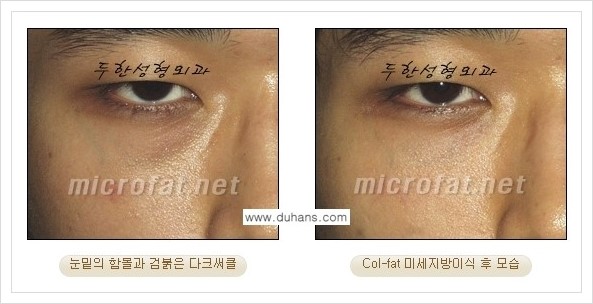 [두한성형외과 경쟁력 눈밑성형] - [눈밑 다크써클과 눈밑 함몰주름의 최적화 교정방법 안내] 관련 이미지 28
