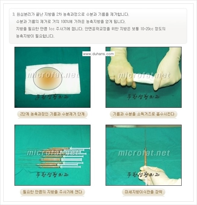 ⁠⁠[두한성형외과 경쟁력 볼살지방이식] - [심하게 야윈 주름이 있는 얼굴, 역삼각형 협소한 얼굴, 광대뼈가 돌출되어 보이는 경우 안내] 관련 이미지 7