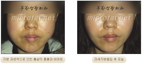 [두한성형외과 지방이식] - [타병원의 지방이식 부작용 교정] 관련 이미지 25