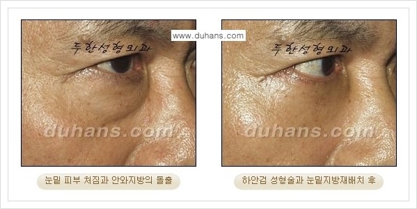 [두한성형외과 경쟁력 눈성형] - [젊은 눈매로의 복원 안검성형] 관련 이미지 31
