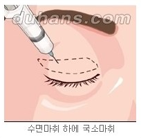 [두한성형외과 안검성형] - [상안검, 하안검] 관련 이미지 2