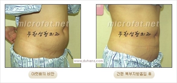 [두한성형외과 경쟁력 지방흡입] - [초음파 지방흡입과 미세흡입관을 이용한 간편지방흡입] 관련 이미지 8