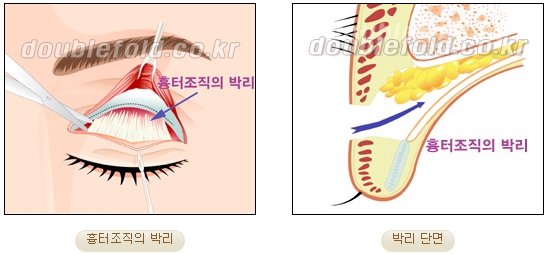 [두한성형외과 쌍커풀재수술] - [심한 소세지눈, 두줄따기, 쌍꺼풀 흉터] 관련 이미지 10
