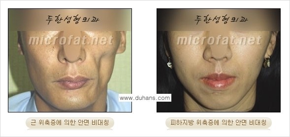 [두한성형외과 경쟁력 미세지방이식] - [타 병원에서 볼살 지방이식 이후 부작용 교정 방법 안내] 관련 이미지 3