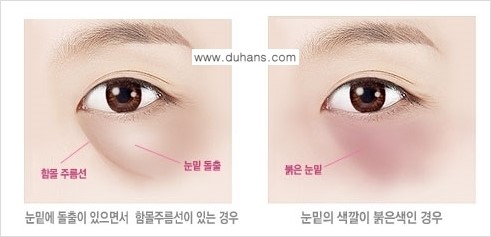 [두한성형외과 경쟁력 다크써클 치료] - [다크써클 5단계로 이뤄지는 핵심 5 STEP SOLUTION 안내 1.] 관련 이미지 5