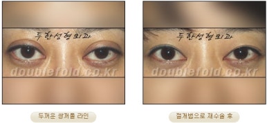 [두한성형외과 쌍커풀재수술] - [심한 소세지눈, 두줄따기, 쌍꺼풀 흉터] 관련 이미지 16