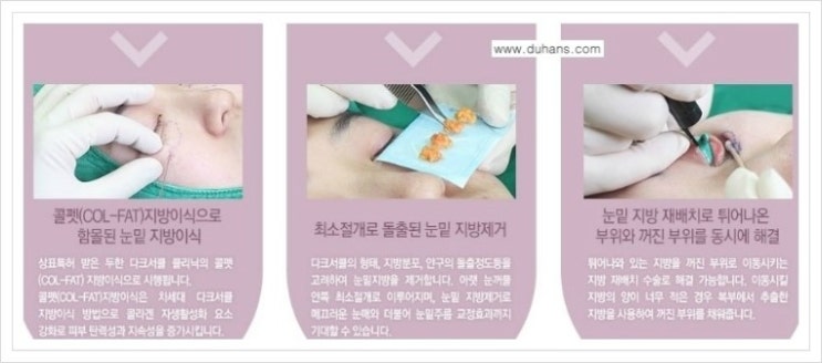 [두한성형외과 경쟁력 다크써클 교정] - [다크써클 5단계로 이뤄지는 핵심 5 STEP SOLUTION 안내 1.] 관련 이미지 9