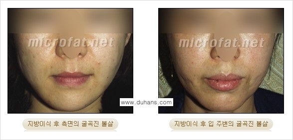 [두한성형외과 "미세지방이식"] - [지방이식 부작용 교정 정보 ①] 관련 이미지 11