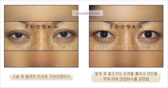[두한성형외과 경쟁력 눈성형] - [극한 재수술, 함몰된 눈꺼풀 라인교정, 안검하수(졸리운 눈매)] 관련 이미지 87