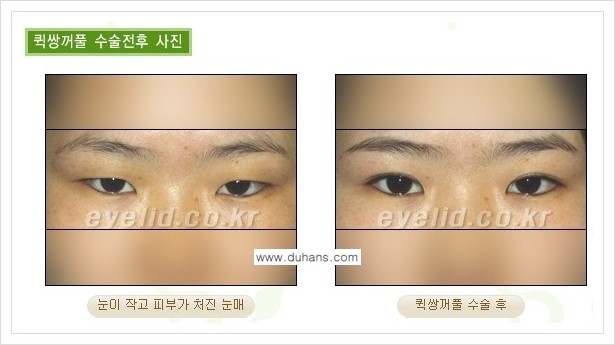 [두한성형외과 경쟁력 눈성형] - [퀵쌍꺼풀 수술] 관련 이미지 9