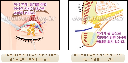 [두한성형외과 쌍수] - [재수술 실패의 원인, 재수술의 성공 요건] 관련 이미지 14