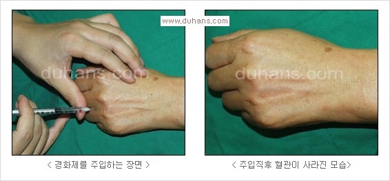 [두한성형외과 경쟁력 정맥류 치료] - [정맥류 치료의 모든 것] 관련 이미지 30