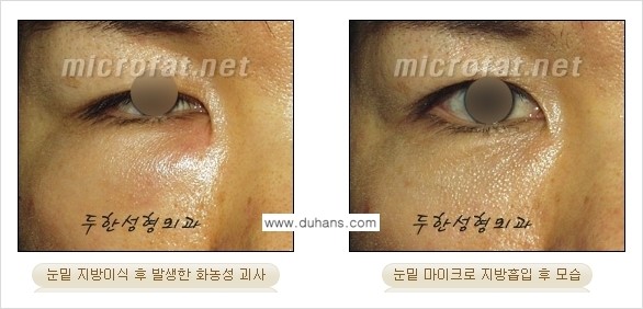 [두한성형외과 경쟁력 미세지방흡입] - [안면부의 안전한 미세지방흡입 안내] 관련 이미지 14