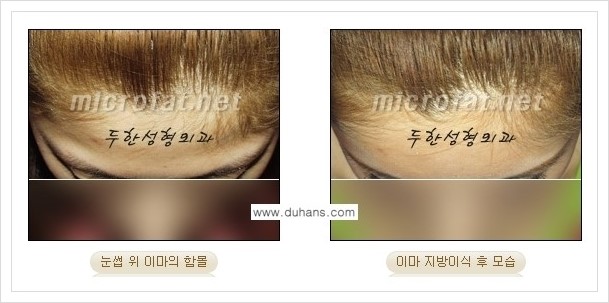 [두한성형외과 경쟁력 미세지방이식] - [부드럽고 아름다운 얼굴 윤곽선 이마(전두부) 미세지방이식] 관련 이미지 9