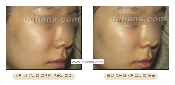 ​​​﻿[두한성형외과 경쟁력 간편지방흡입] - [볼살지방흡입, 턱선지방흡입 안내] 관련 이미지 6