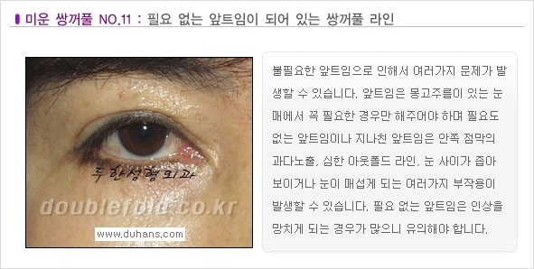 [두한성형외과 경쟁력 쌍꺼풀 재수술, 극한 재수술] - [일반적인 기준의 미운 쌍꺼풀과 아름다운 쌍꺼풀 안내] 관련 이미지 11