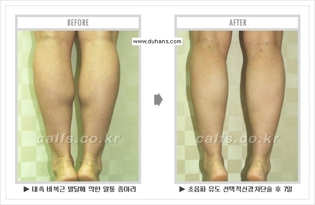 [두한성형외과 경쟁력 멀티종아리성형] - [종아리성형 방법별 전후 주의사항] 관련 이미지 16