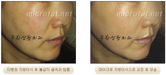 얼굴지방이식 두한성형외과 - 볼지방이식 관련 이미지 35