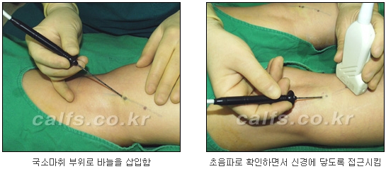 [두한성형외과 종아리퇴축술] - [NO절개! 초음파유도신경차단술] 관련 이미지 12