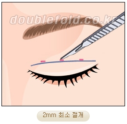 두한성형외과 쌍커풀재수술 - 삼중 쌍커풀 라인 교정 관련 이미지 8