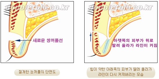 [두한성형외과 쌍커풀재수술] - [심한 소세지눈, 두줄따기, 쌍꺼풀 흉터] 관련 이미지 7