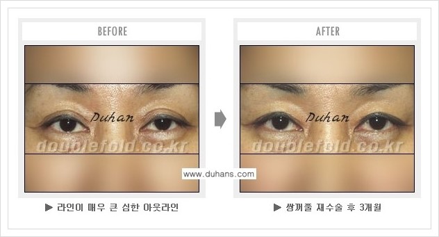 [두한성형외과 경쟁력 쌍꺼풀(눈) 재수술] - [쌍꺼풀 재수술시 잘못된 수술로 인한 넓어진 흉터 처리 안내] 관련 이미지 7