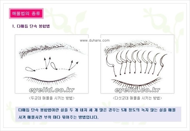[두한성형외과 경쟁력 눈성형] - [절개법, 매몰법 쌍꺼풀 수술 안내] 관련 이미지 4