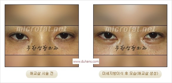[두한성형외과 경쟁력 미세지방이식] - [애교살 필러 시술의 부작용 교정] 관련 이미지 9