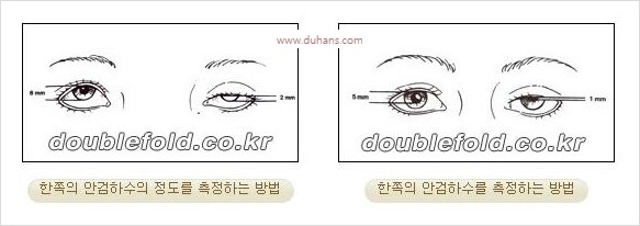 ⁠⁠[두한성형외과 경﻿쟁력 쌍꺼풀 재수술] - [안검하수(졸리운 눈매) 종류와 교정 방법 안내] 관련 이미지 3