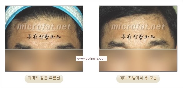 [두한성형외과 경쟁력 주름성형] - [주름 교정을 위한 안전하고 효과적인 미세지방이식] 관련 이미지 15