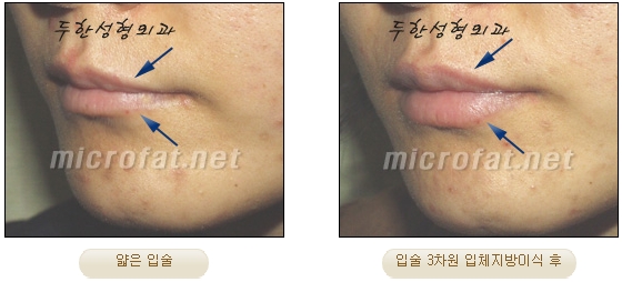 [Duhan Plastic Surgery Lip Surgery] - [Lip Correction Fat Grafting] image 19
