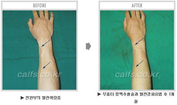 [종아리성형 두한성형외과] - [종아리수술에 대한 자주하는 질문과 답변 모음] 관련 이미지 42
