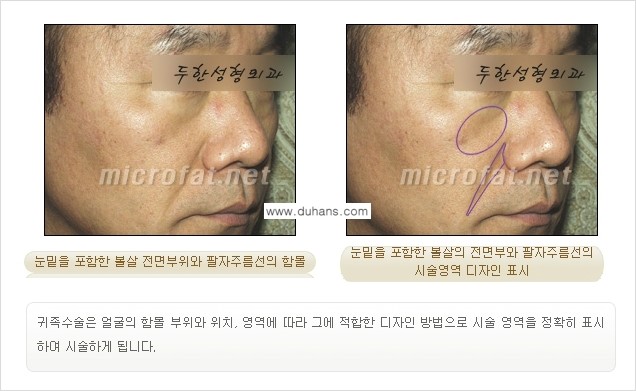 [두한성형외과의 경쟁력 미세지방이식] - [귀족수술과 인디언밴드 미세지방이식 안내 ①] 관련 이미지 9