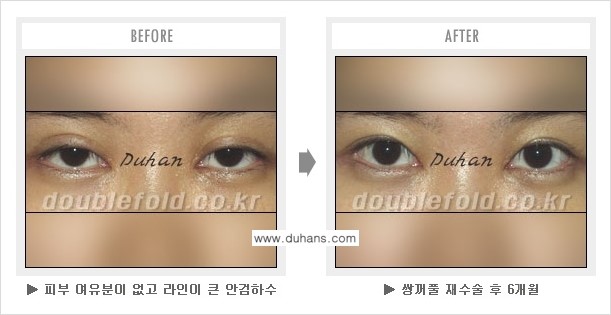 [두한성형외과] - [쌍꺼풀 재수술에서 매우높은 흉터선의 처리 문제] 관련 이미지 3