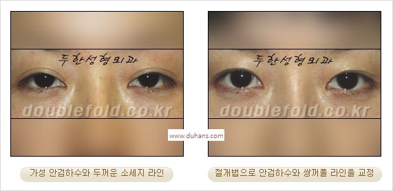 ⁠⁠[두한성형외과 경﻿쟁력 쌍꺼풀 재수술] - [안검하수(졸리운 눈매) 종류와 교정 방법 안내] 관련 이미지 28