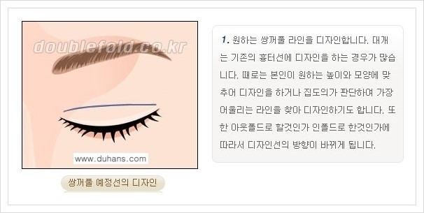 [두한성형외과 경쟁력 쌍꺼풀 재수술, 극한 재수술] - [쌍꺼풀 재수술의 과정 안내 1.] 관련 이미지 11