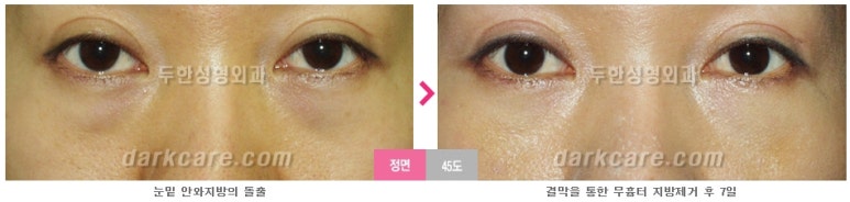 [두한성형외과 다크서클] - [다크서클 전후사진 검증] 관련 이미지 90