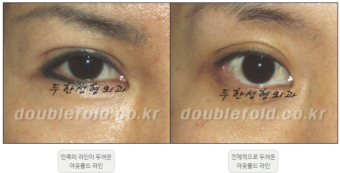 [Double Eyelid Surgery Duhan Plastic Surgery] - [Revision Methods] image 2