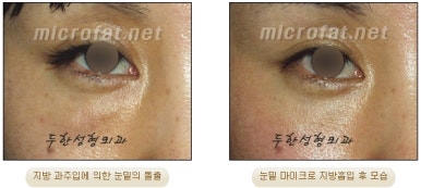 Facial Fat Liposuction at Duhan Plastic Surgery - Cheek Fat Liposuction, Jawline Liposuction, Under-Eye Fat Liposuction image 27